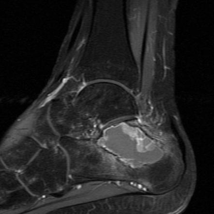 Aneurysmal bone cyst of the calcaneus | Image | Radiopaedia.org