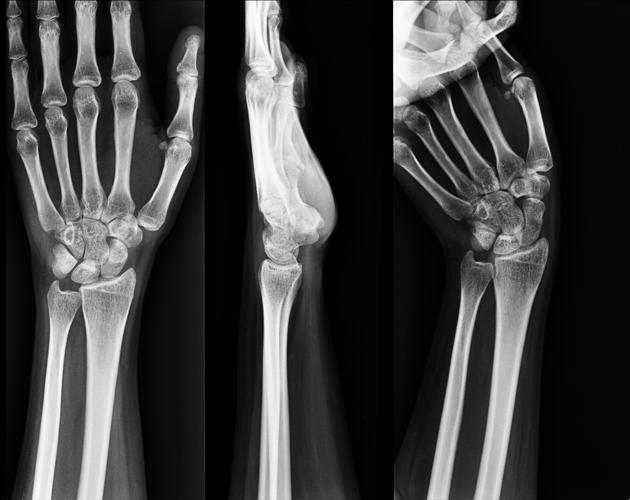 Scaphoid-FOOSH – OrthoPaedia