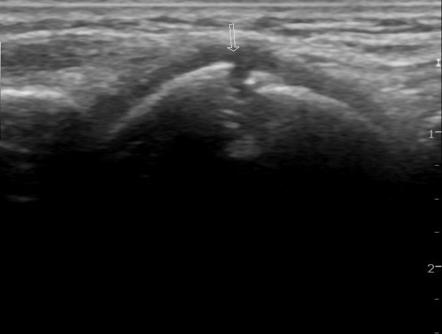 Scaphoid fracture | Radiology Reference Article | Radiopaedia.org