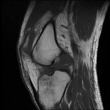 Medial Collateral Ligament Avulsion Injury | Image | Radiopaedia.org