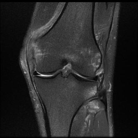 Medial collateral ligament avulsion injury | Image | Radiopaedia.org