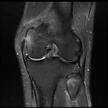 Medial collateral ligament injury of the knee | Radiology Reference ...