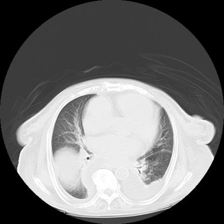 Metastatic thyroid carcinoma | Image | Radiopaedia.org