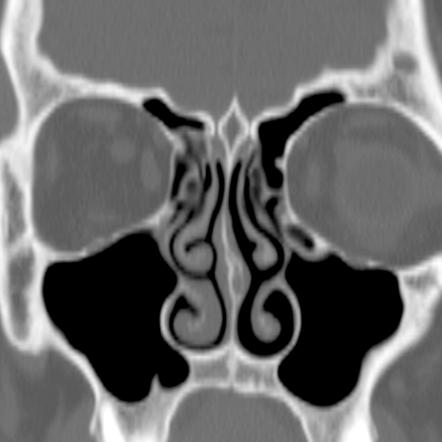 Haller cells | Radiology Reference Article | Radiopaedia.org