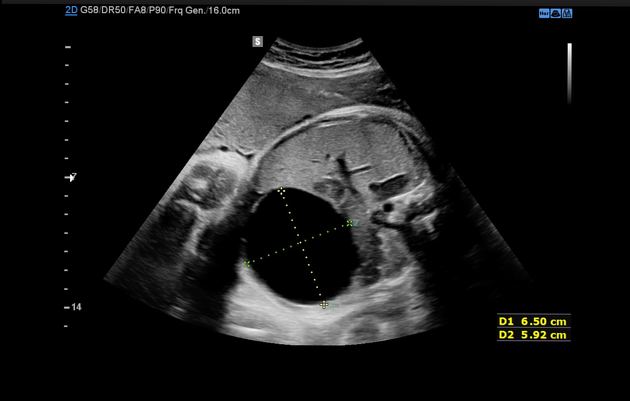 Ruptured ovarian cyst, Radiology Reference Article