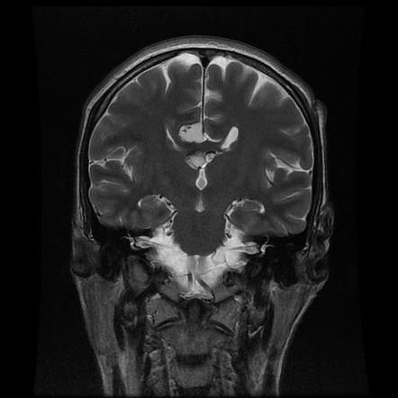 Pericallosal lipoma | Image | Radiopaedia.org