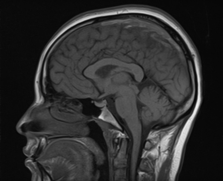 Postpartum cerebral venous thrombosis with hemorrhagic venous infarcts ...