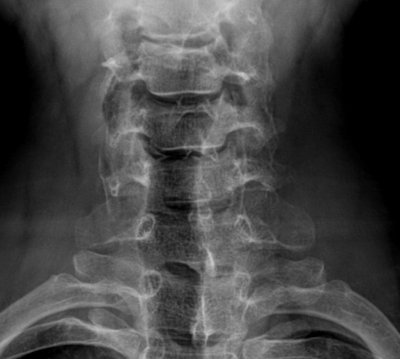 Clay-shoveler Fracture | Image | Radiopaedia.org