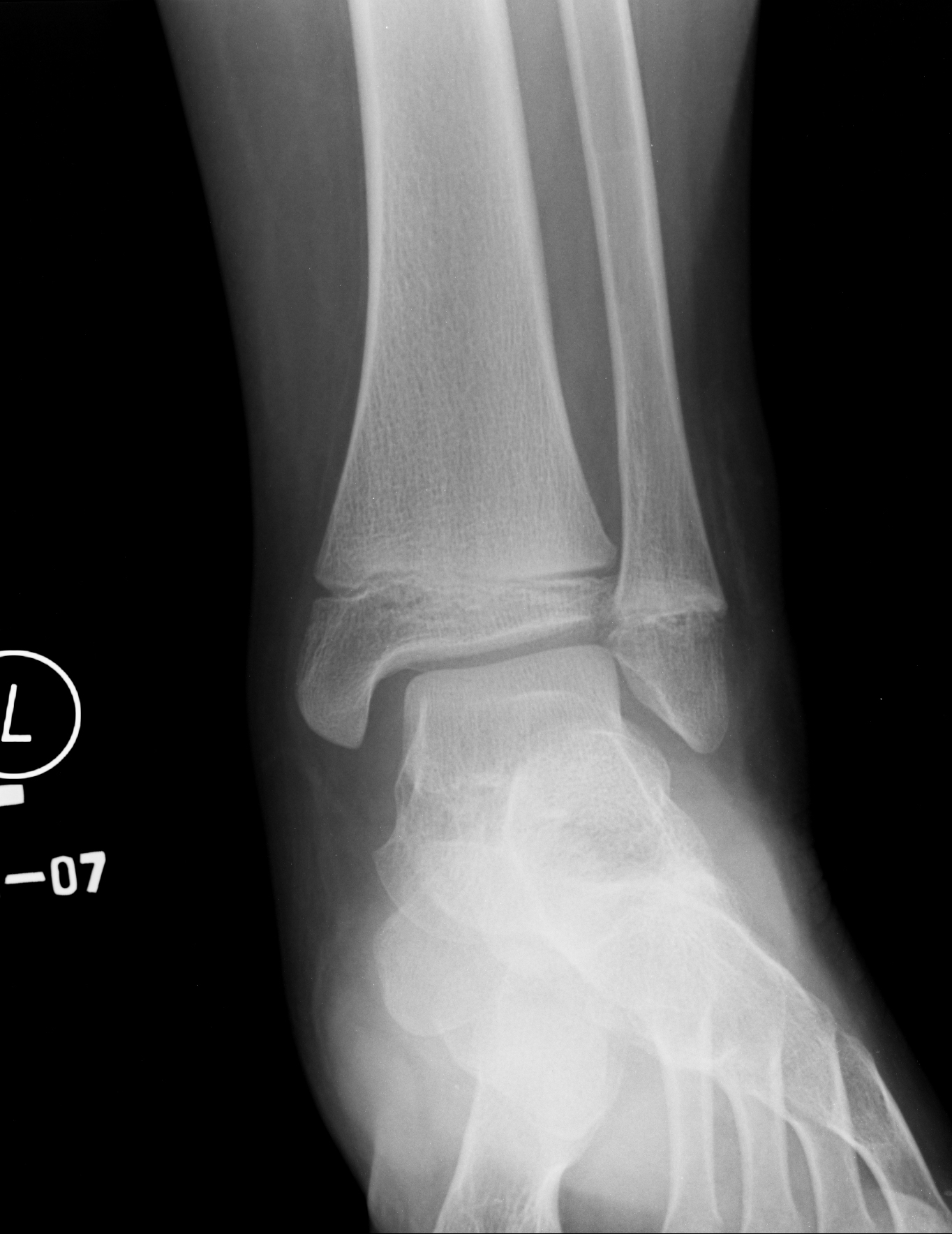 Salter-Harris type II fracture | Image | Radiopaedia.org