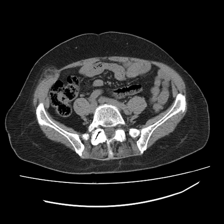 Epiploic appendagitis within a Spigelian hernia | Radiology Case ...