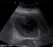 Splenic abscess | Radiology Reference Article | Radiopaedia.org