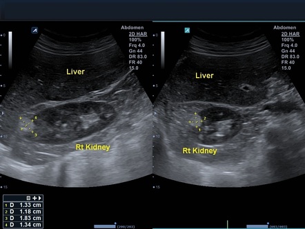 Renal angiomyolipoma | Radiology Reference Article | Radiopaedia.org