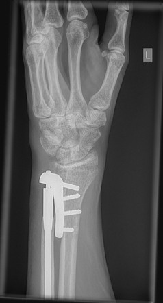 Distal radioulnar joint arthroplasty with Scheker prosthesis | Image ...