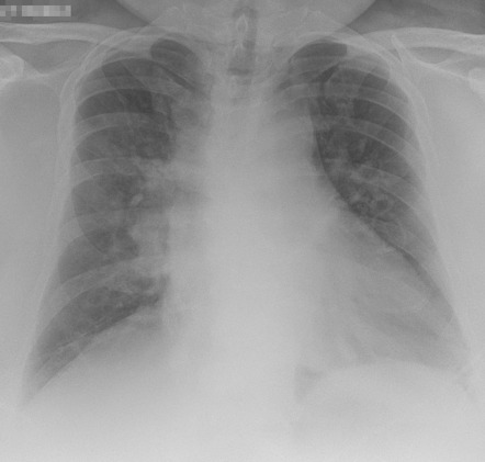 Acute aspiration pneumonitis | Radiology Case | Radiopaedia.org