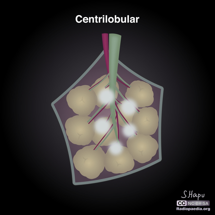 Centrilobular Lung Nodules 