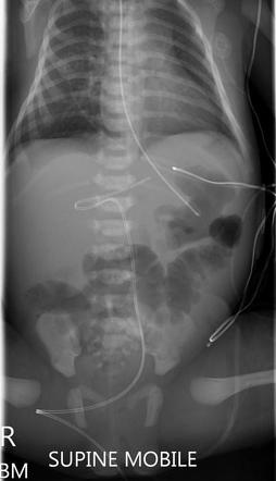 Umbilical venous catheters | Radiology Reference Article | Radiopaedia.org