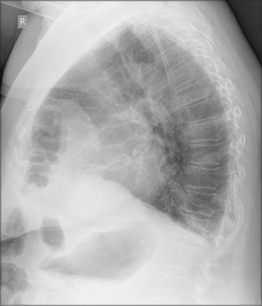 Morgagni hernia | Radiology Case | Radiopaedia.org