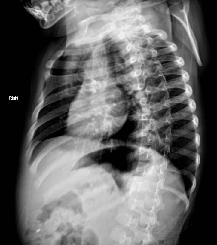 Bifid rib | Image | Radiopaedia.org