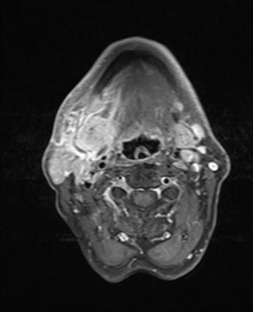 Acute submandibular sialadenitis (MRI) | Image | Radiopaedia.org