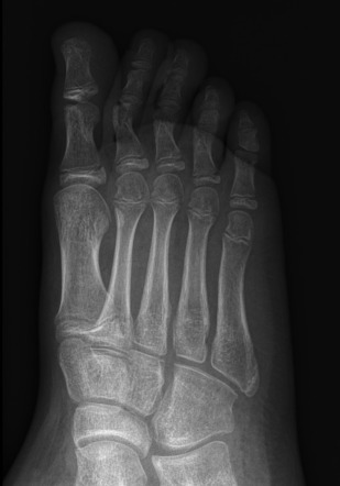 Apophysis of the proximal 5th metatarsal | Radiology Case | Radiopaedia.org