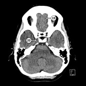 Cavernous Sinus Radiology Reference Article Radiopaedia Org