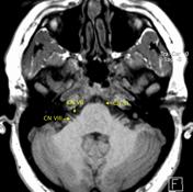 5th of facial nerve mri