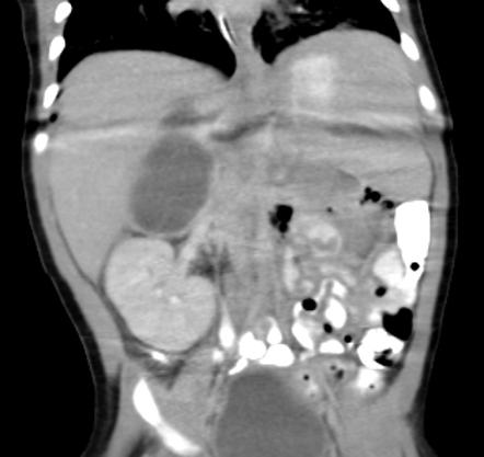 Adrenal hemorrhage | Radiology Reference Article | Radiopaedia.org