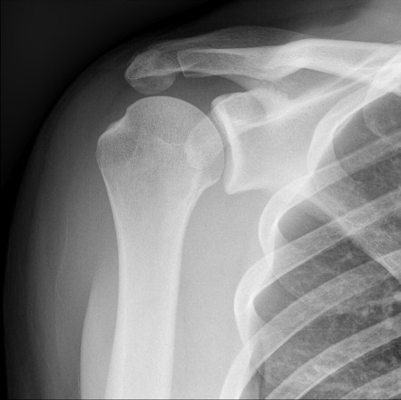 Os acromiale | Radiology Reference Article | Radiopaedia.org