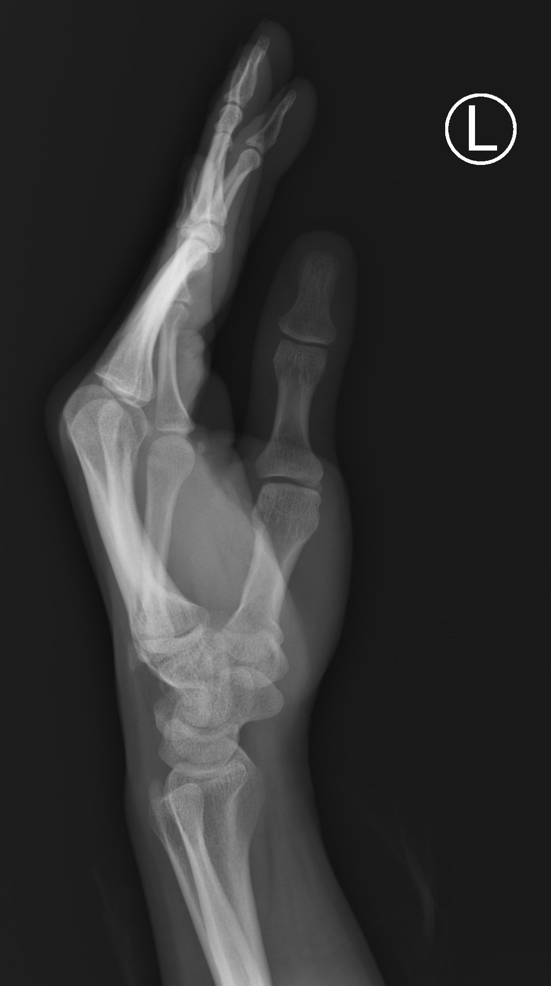 Hamate fracture subluxation | Image | Radiopaedia.org