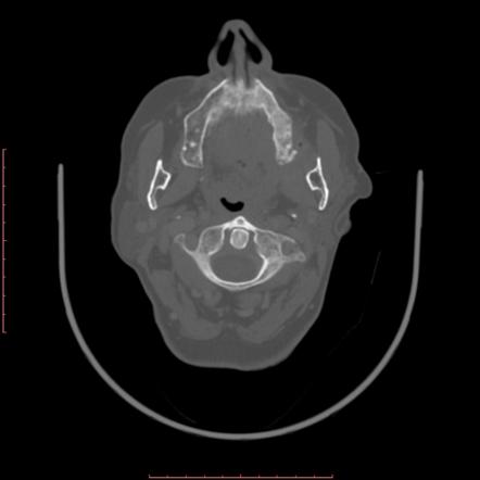 Chronic osteomyelitis - maxilla | Radiology Case | Radiopaedia.org