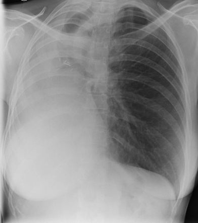 Pneumonectomy | Radiology Case | Radiopaedia.org