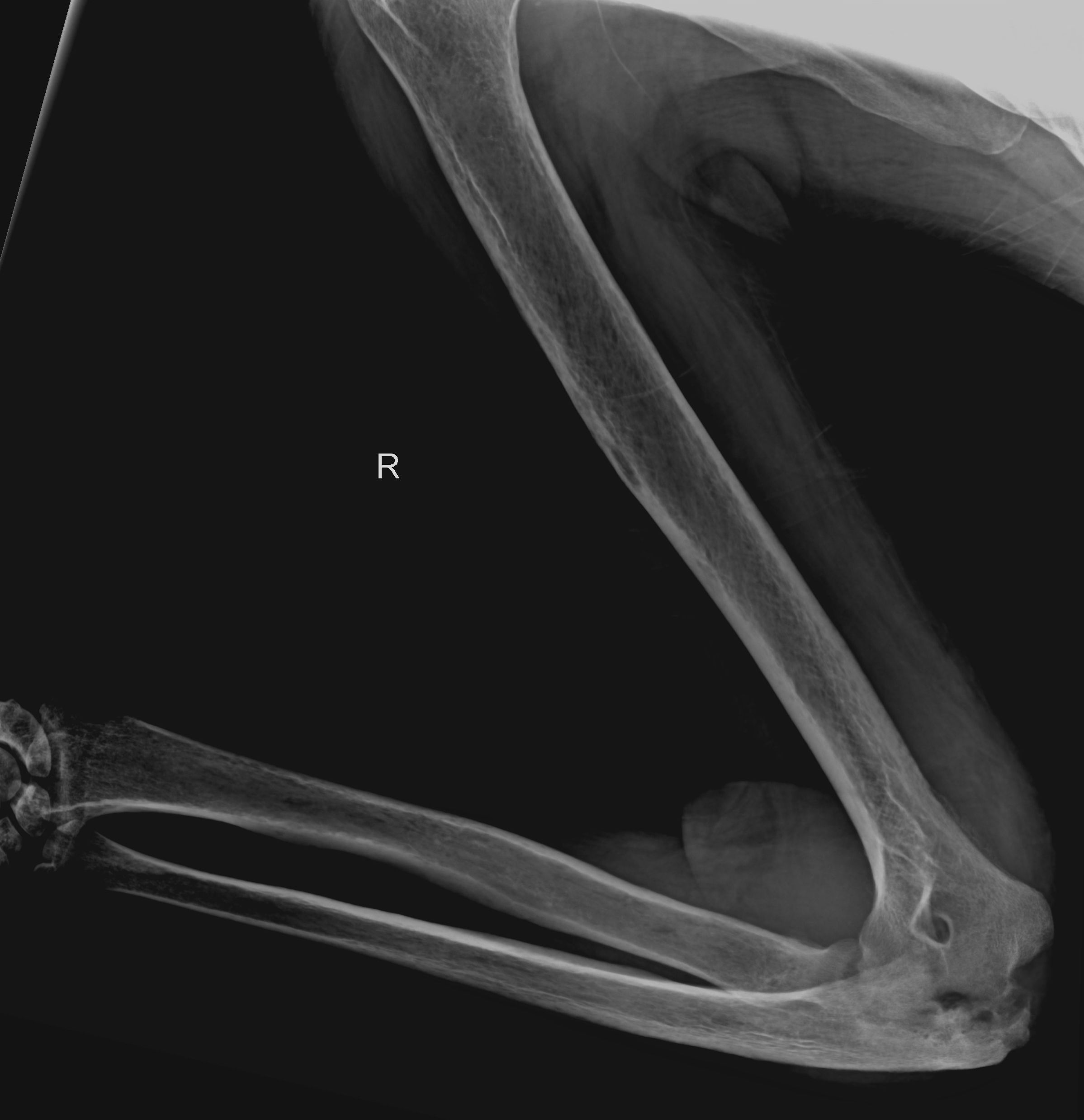 File:Osteomyelitis of elbow (Radiopaedia 62447-70687 Lateral flipped ...