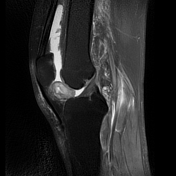 Soft tissue chondroma of the Hoffa fat pad | Radiology Reference ...