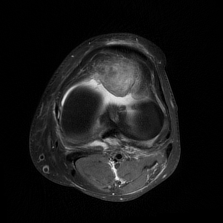 Intracapsular chondroma of the knee | Radiology Case | Radiopaedia.org