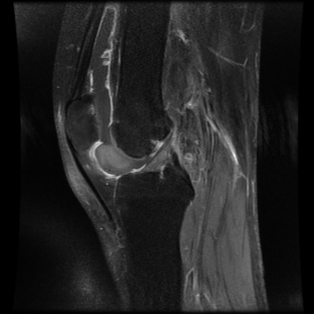 Intracapsular chondroma of the knee | Image | Radiopaedia.org