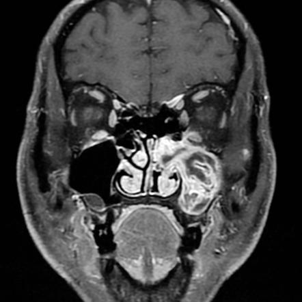 Inverted papilloma | Image | Radiopaedia.org