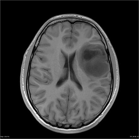 Diffuse astrocytoma NOS (