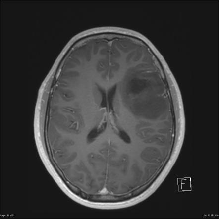 Diffuse astrocytoma NOS (