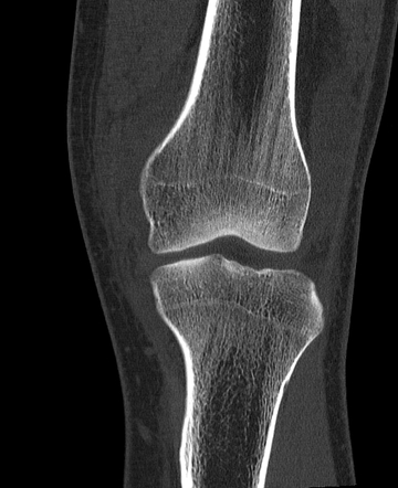 Patellar avulsion fracture, articular loose body, old Stieda-Pellegrini ...