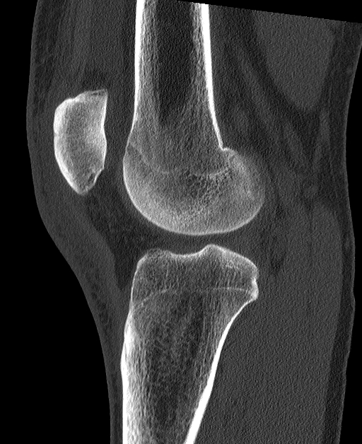 File:Patellar avulsion fracture, articular loose body, old Stieda ...