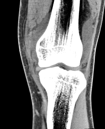 Patellar avulsion fracture, articular loose body, old Stieda-Pellegrini ...