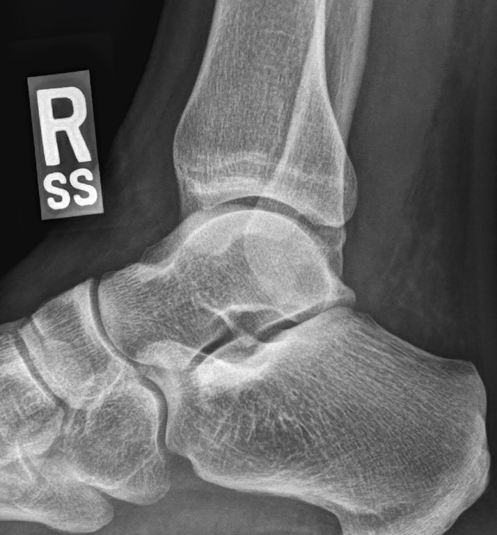 Calcaneofibular avulsion fracture | Image | Radiopaedia.org