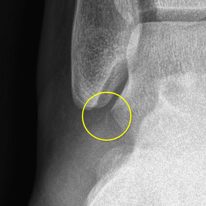 Calcaneofibular avulsion fracture | Image | Radiopaedia.org