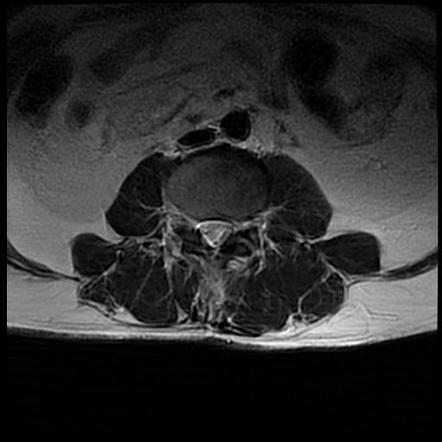 Schwannoma - spine | Image | Radiopaedia.org