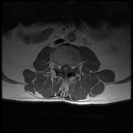 Schwannoma - spine | Image | Radiopaedia.org