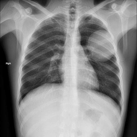 Pulmonary Hydatid Infection 