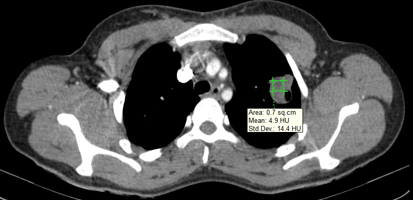 Pulmonary Hydatid Cysts | Image | Radiopaedia.org