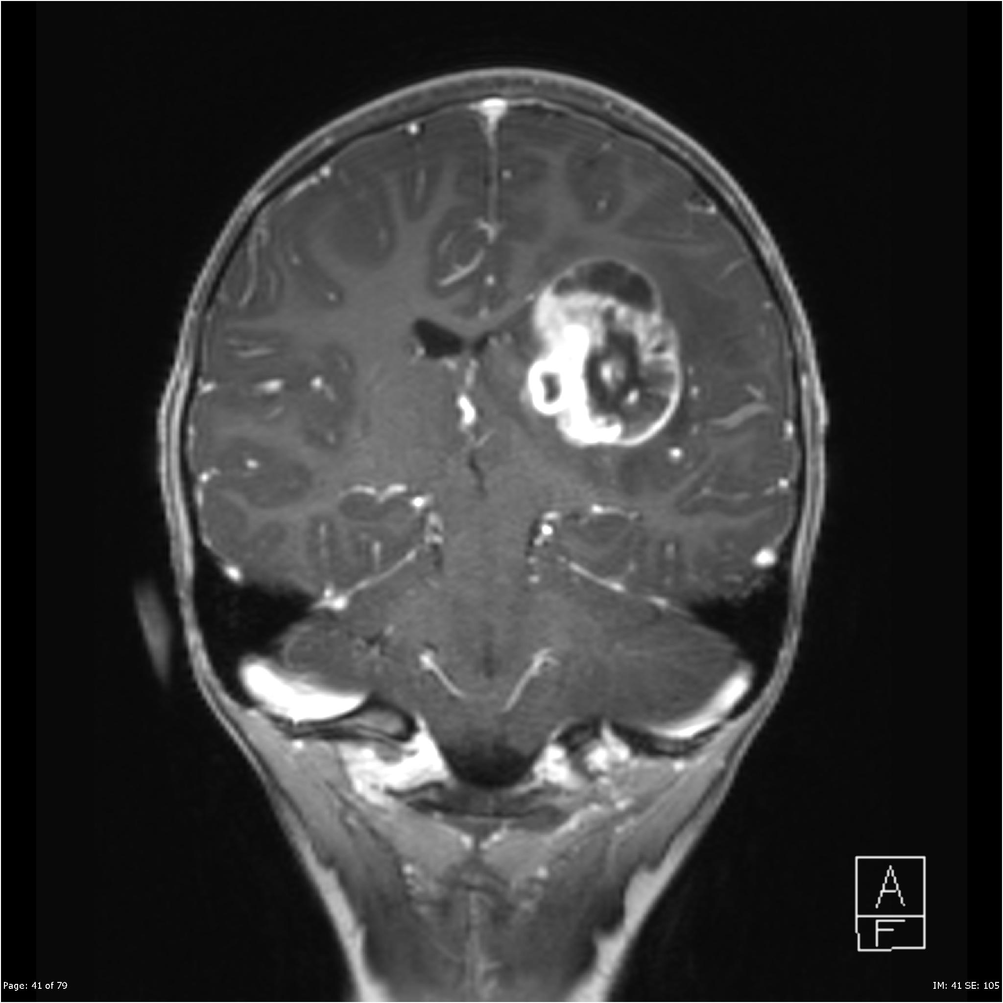 Supratentorial Pilocytic Astrocytoma Image