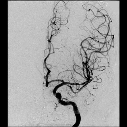 Duplicated Middle Cerebral Artery Radiology Reference Article