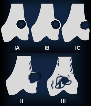 Lodwick classification of lytic bone lesions | Radiology Reference ...